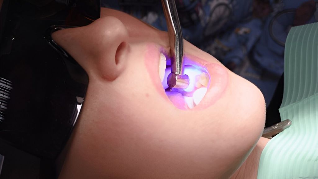 composite fillings in sw calgary