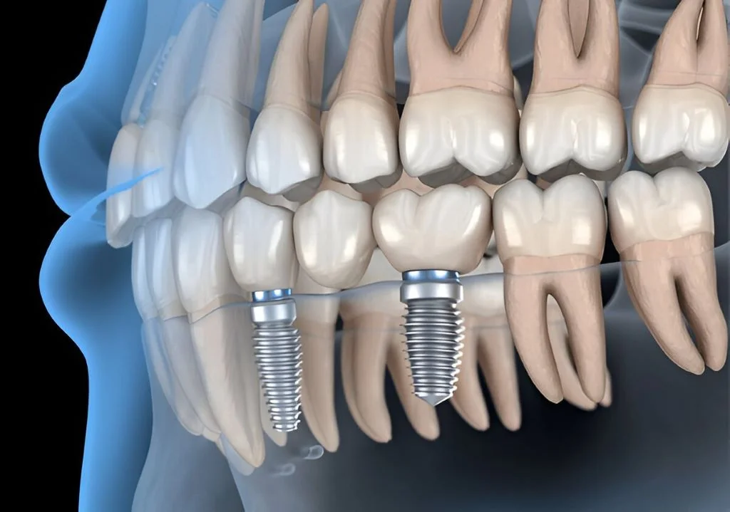 dental bridges near you