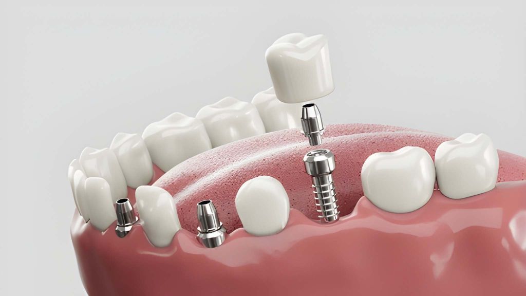 dental implants near you