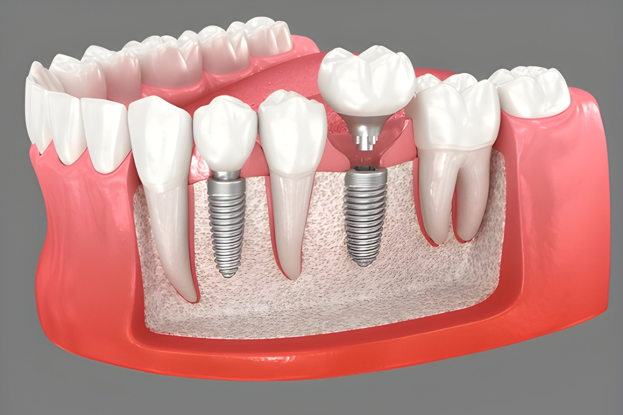 dental implants sw calgary