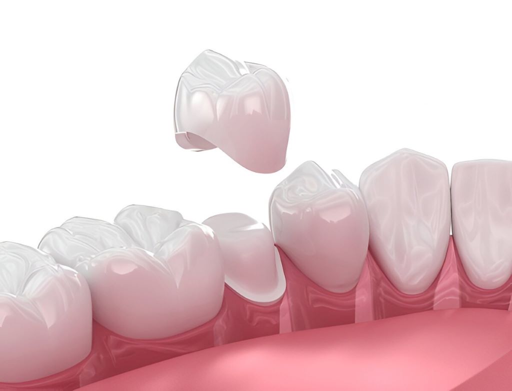 porcelain crowns in sw calgary