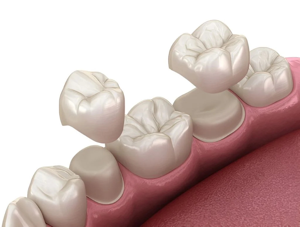 porcelain crowns near you
