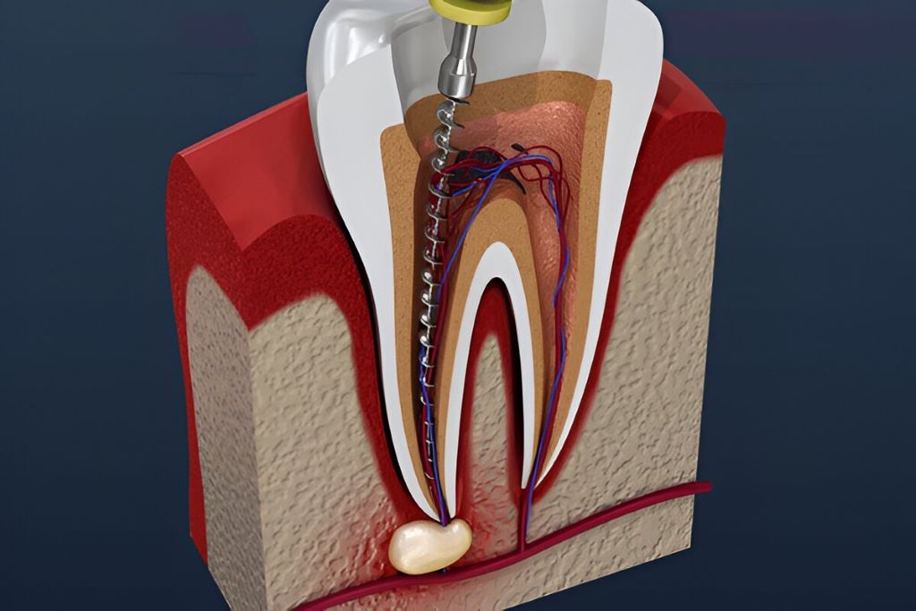 root canal therapy in sw calgary