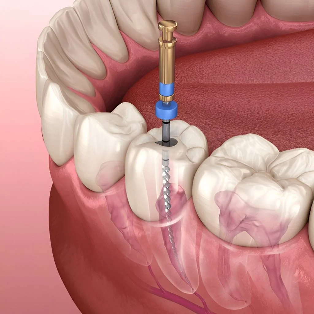 root canal therapy near you