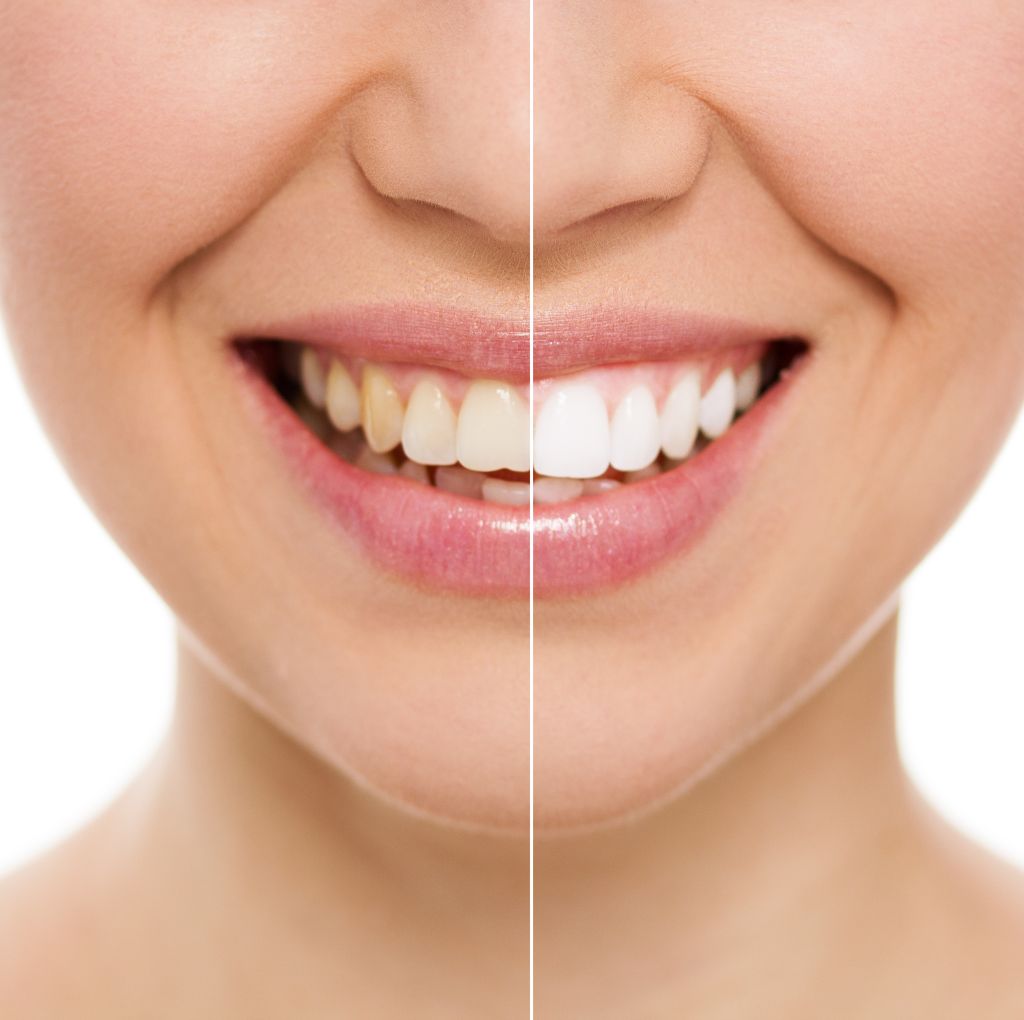 teeth whitening near you