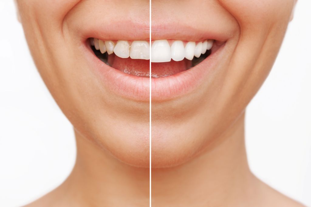 veneers in sw calgary