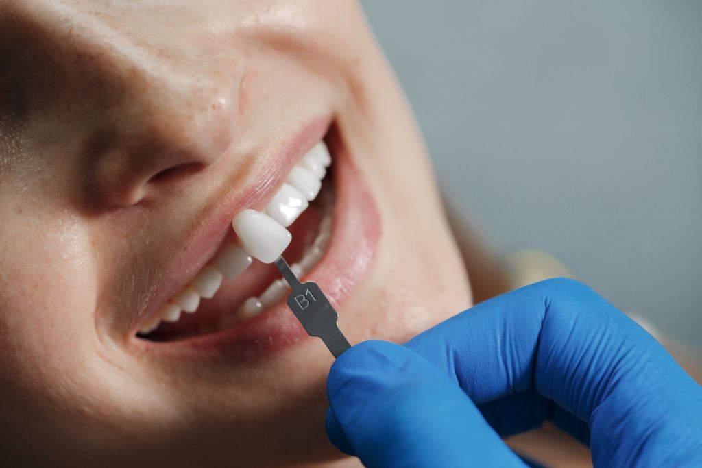 veneers near you