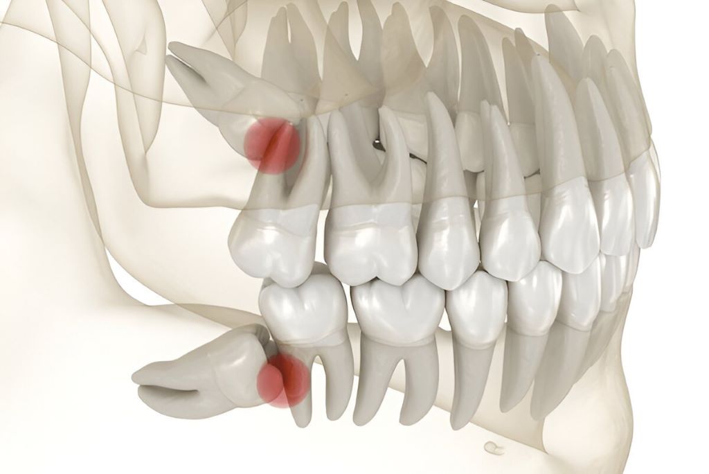 wisdom tooth extractions in sw calgary