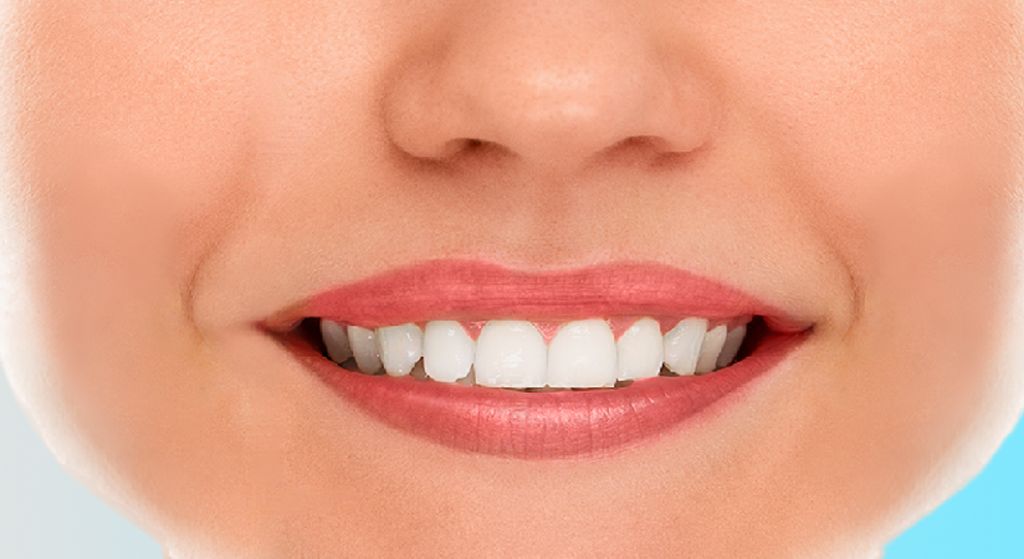 post veneer instructions