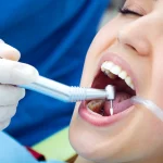 what are composite fillings a guide for sw calgary patients