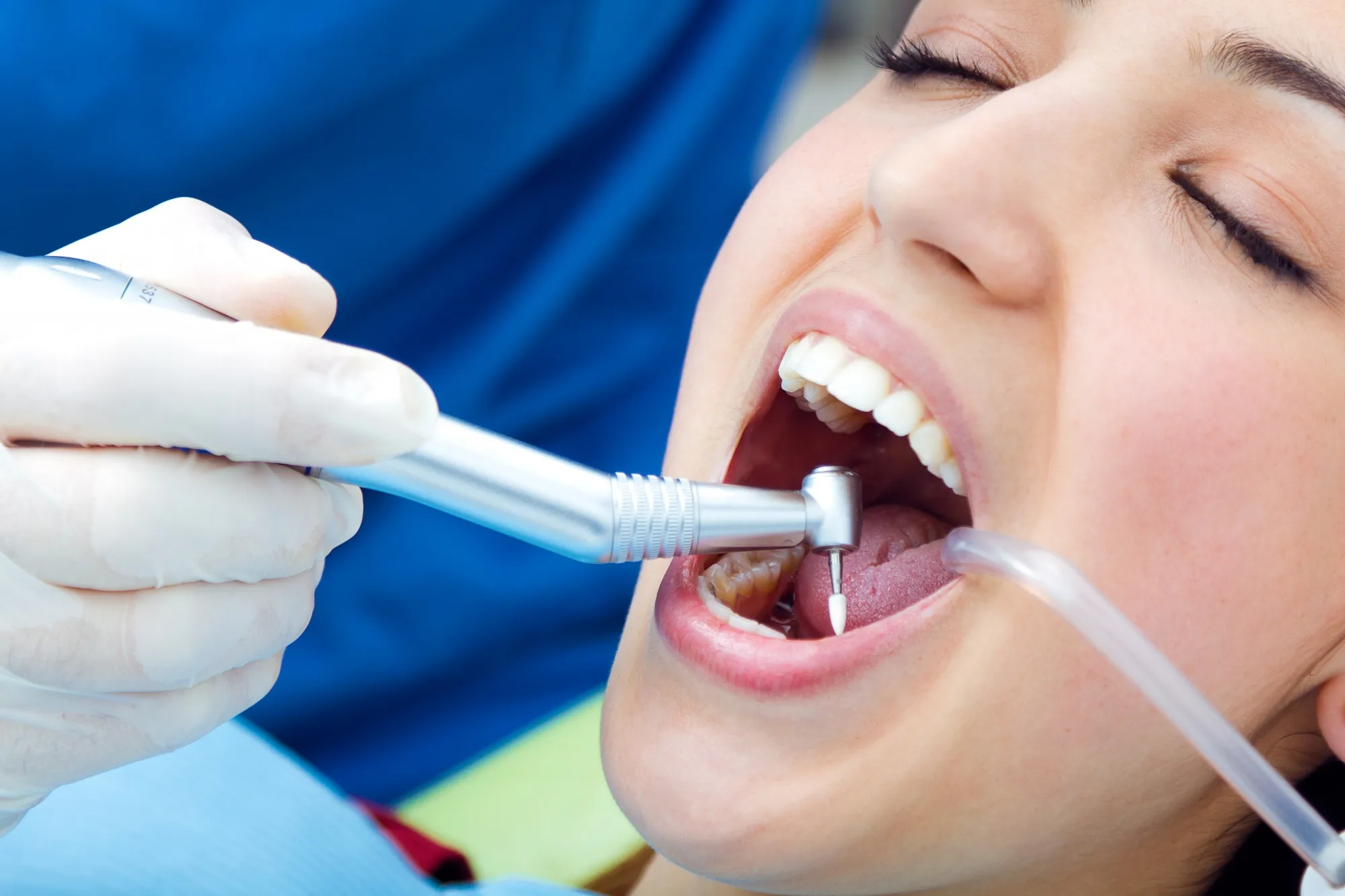 what are composite fillings a guide for sw calgary patients